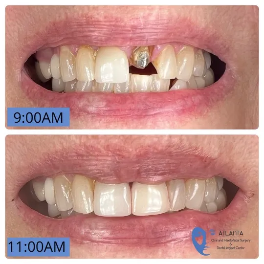 tooth implant before and after